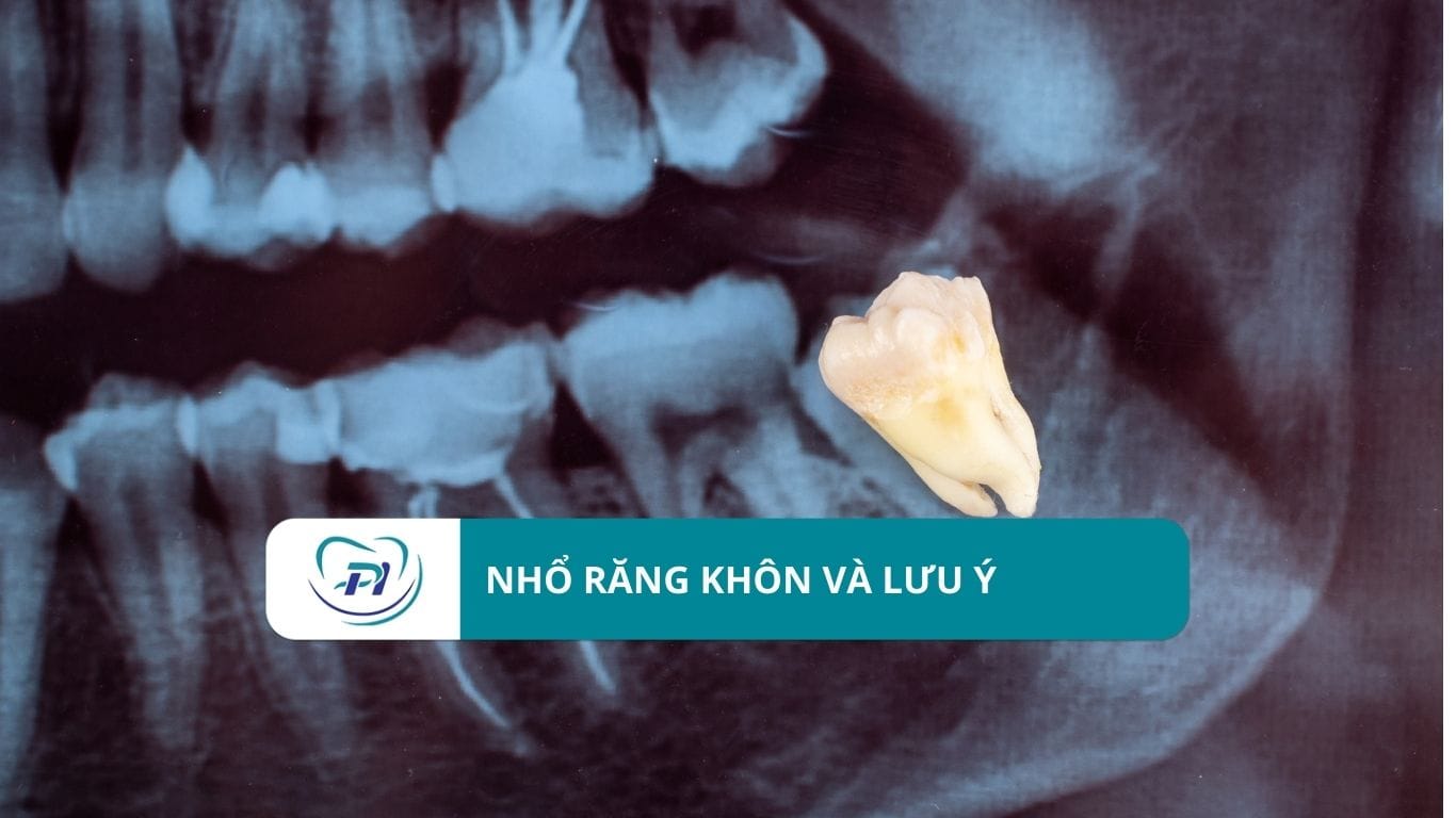 Nhổ răng khôn có quy trình và những lưu ý gì?