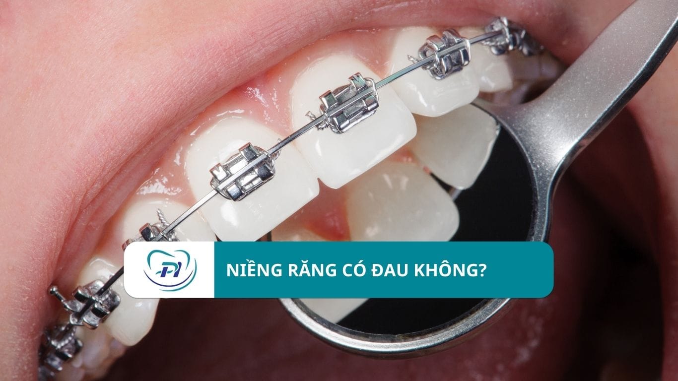 Niềng răng có đau không?